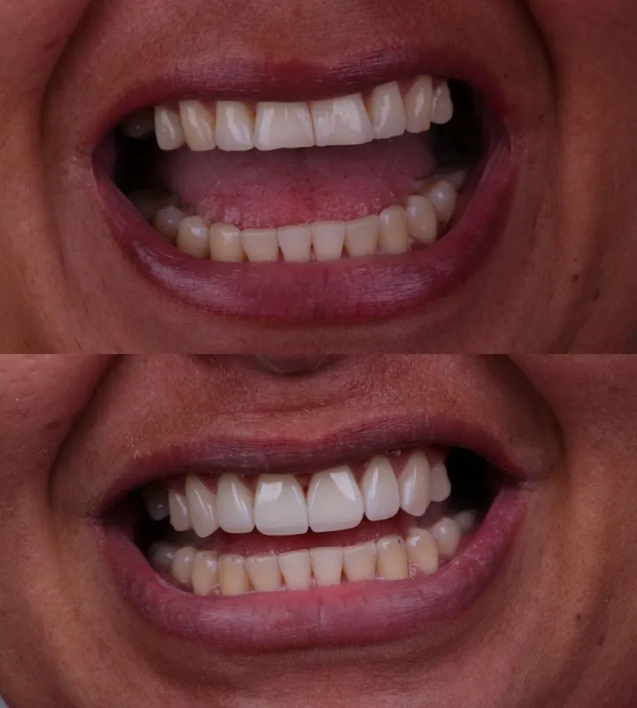 Antes e depois — caso 4