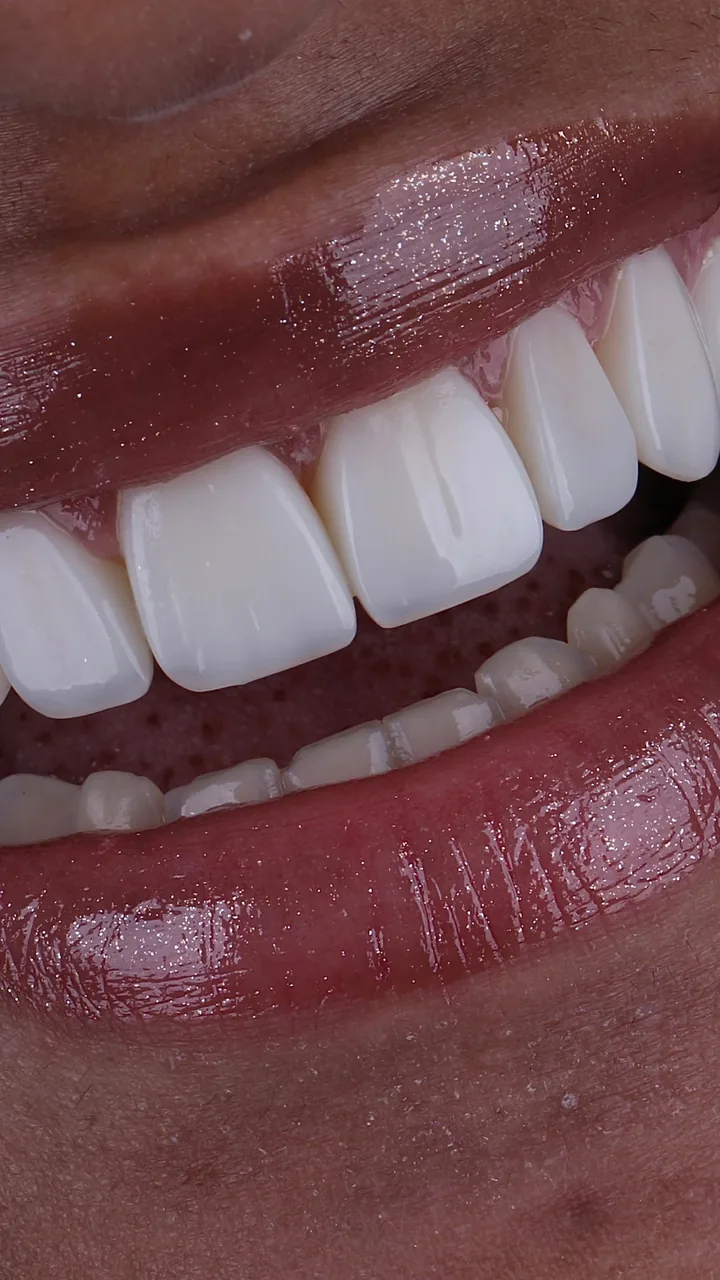Sorriso com facetas em resina — caso 6