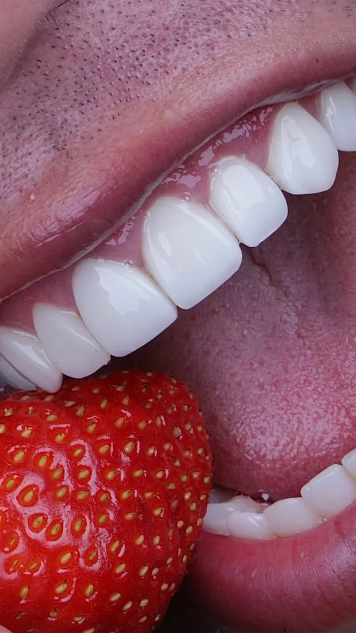 Sorriso com facetas em resina — caso 8